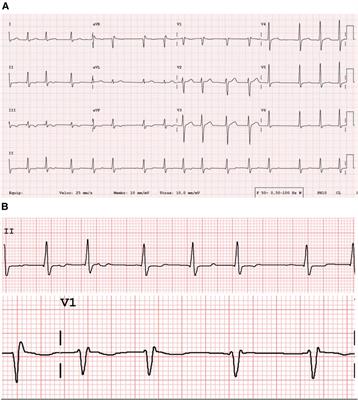 Case report: Mutation in NPPA gene as a cause of fibrotic atrial myopathy